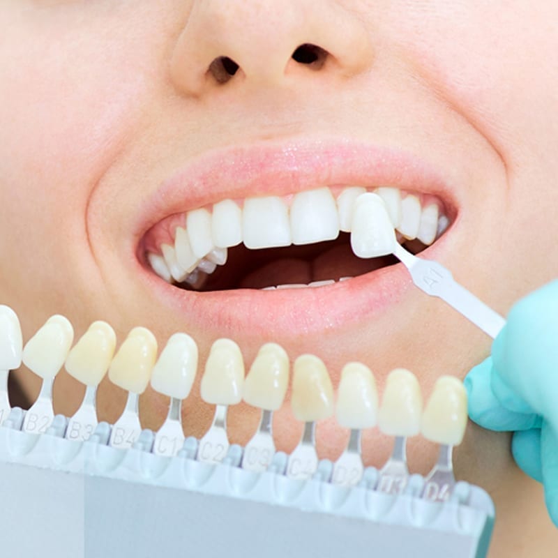 veneers